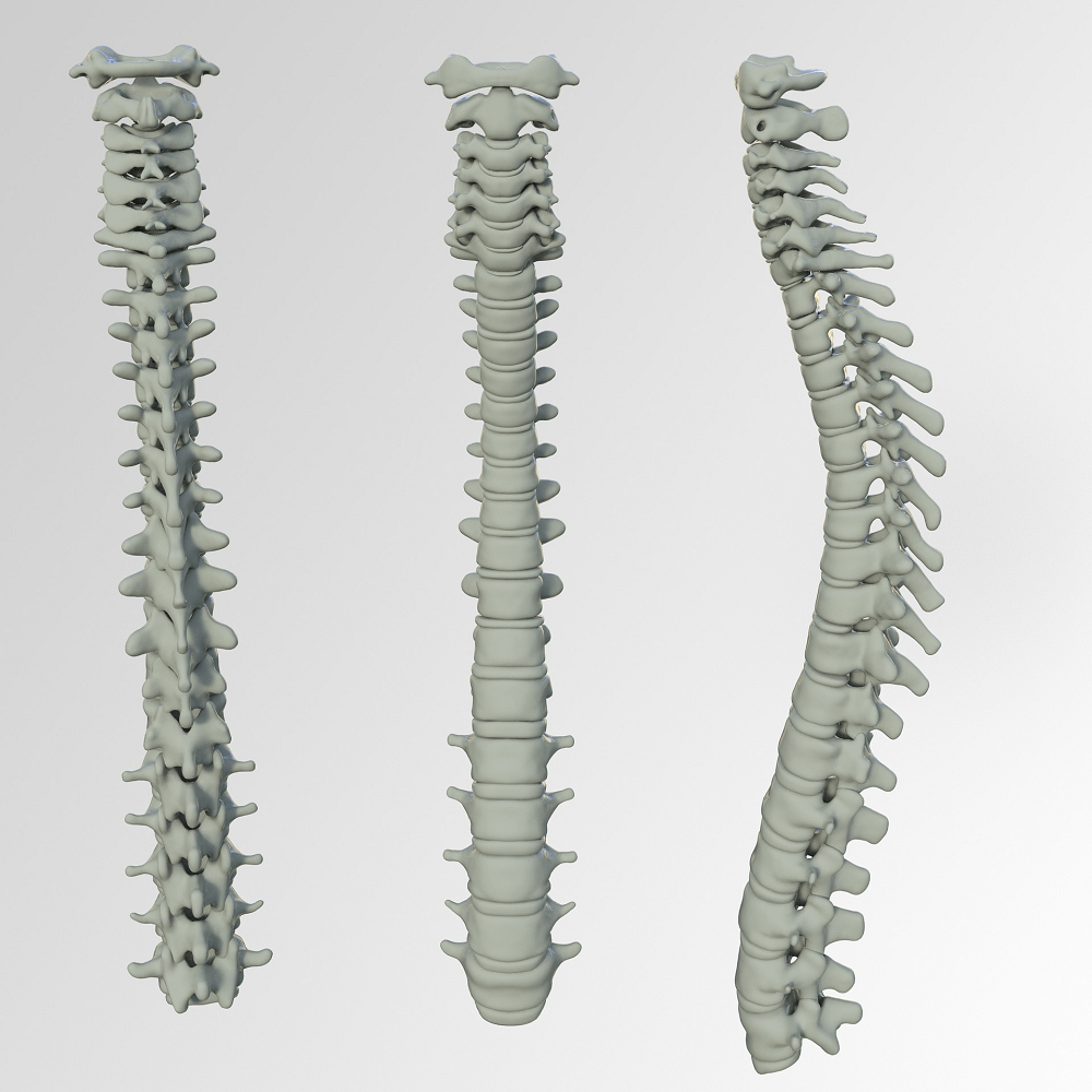 Scoliosis of the Spine