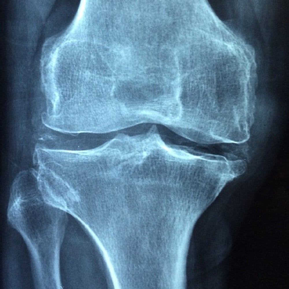 Weight Gain And Knee Pain – A ‘Big’ Link
