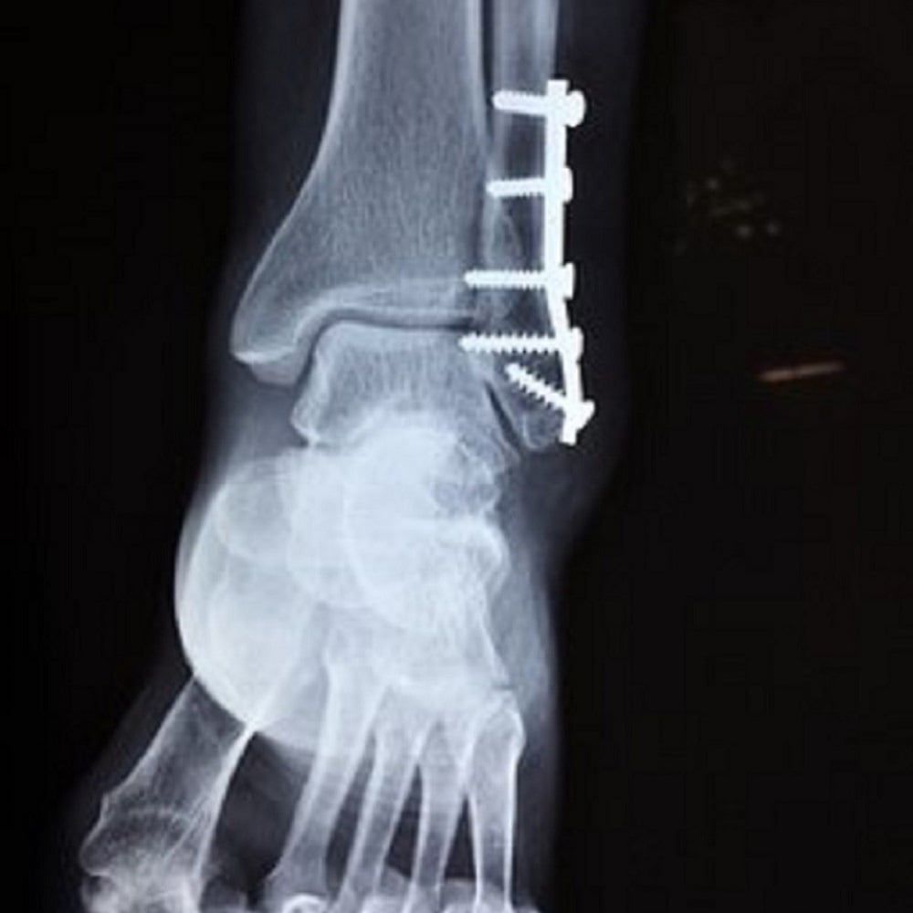 Do I Need To X-Ray My Foot?