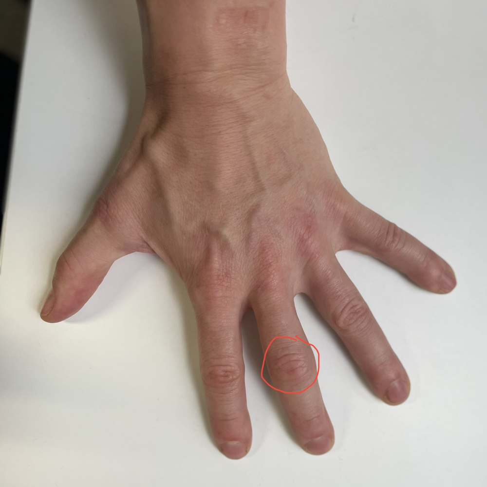 Trigger Finger - Adelaide Plastic & Hand Surgery