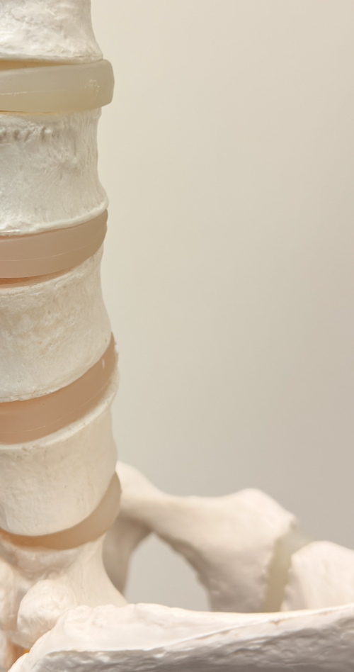 Medical model of the lower spine showing vertebrae, intervertebral discs, and orange nerve roots.