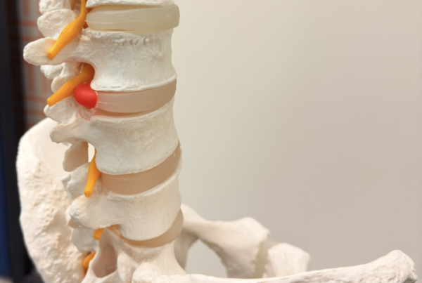 Medical model of the lower spine showing vertebrae, intervertebral discs, and orange nerve roots.