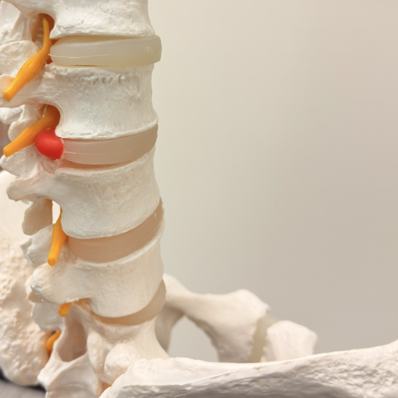 Medical model of the lower spine showing vertebrae, intervertebral discs, and orange nerve roots.