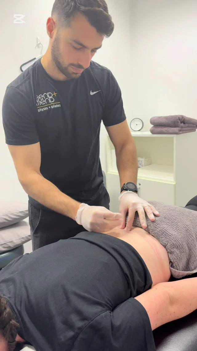 Ever wondered what Dry Needling actually looks like? Dry needling targets specific trigger points to release tension and induce a healing response. There are different sized needles for different muscle groups. Adrian is one of our Physio's that offer dry needling here in the clinic.
#physiosydneycbd #sydneyphysio #DryNeedling #dryneedlingphysio #bendandmend