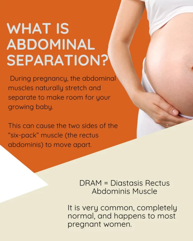 Diastasis Rectus Abdominis (DRAM) is the widening of the linea alba resulting in separation of the rectus abdominis muscles. It commonly occurs during pregnancy and may persist postnatally.While often viewed as a cosmetic concern, DRAM is primarily a functional issue. Reduced tension through the abdominal wall can impact:• Trunk stability and load transfer
• Intra-abdominal pressure management
• Lumbar spine support
• Pelvic floor functionCommon clinical presentations may include:
• Abdominal doming or coning with exertion
• Perceived core weakness
• Lumbopelvic discomfort
• Difficulty returning to higher-level exercise#PhysioLedPilates #PhysioNearMe #SydneyPhysio #bendandmend #pregnancyphysiotherapy p #PregnancyPilates #pregnancypilates